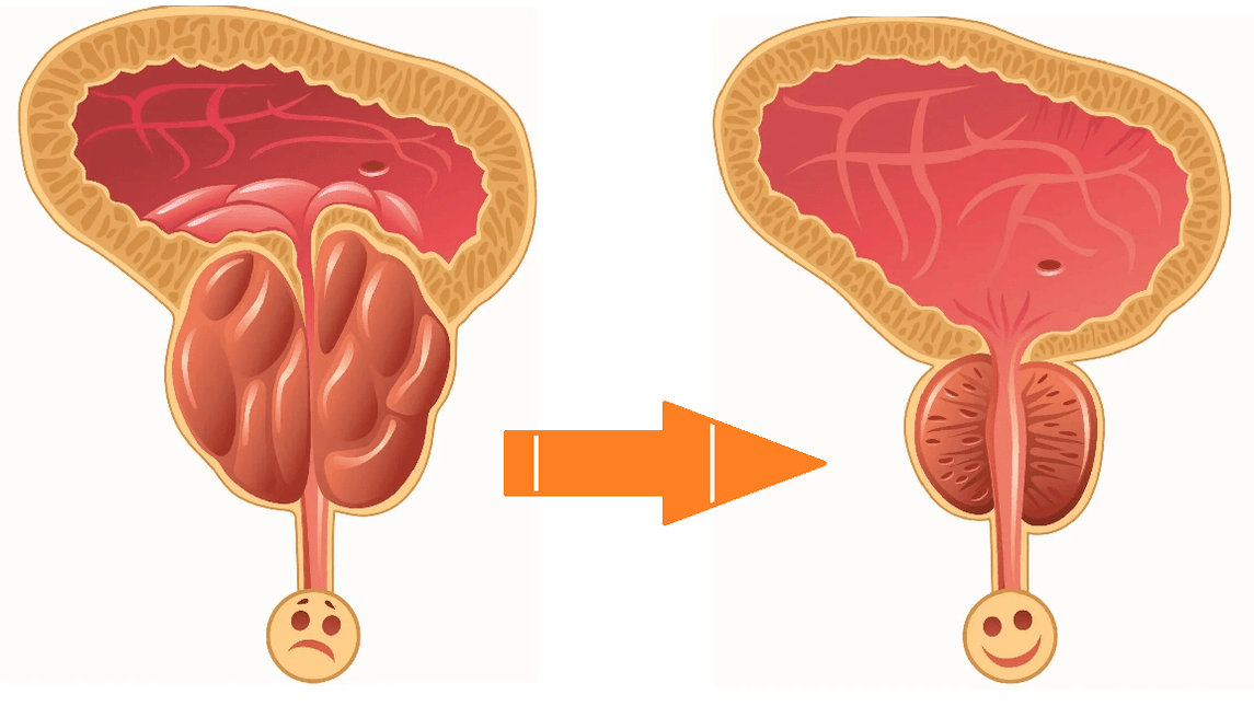 Uromexil Forte -Wirkung auf Prostata mit Prostatitis und Adenom