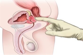 Prostatamassage zur Behandlung chronischer Prostatitis