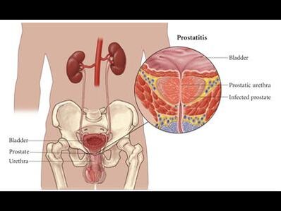 Prostatitis – Entzündung der Prostata