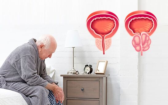 Prostatitis bei einem Mann